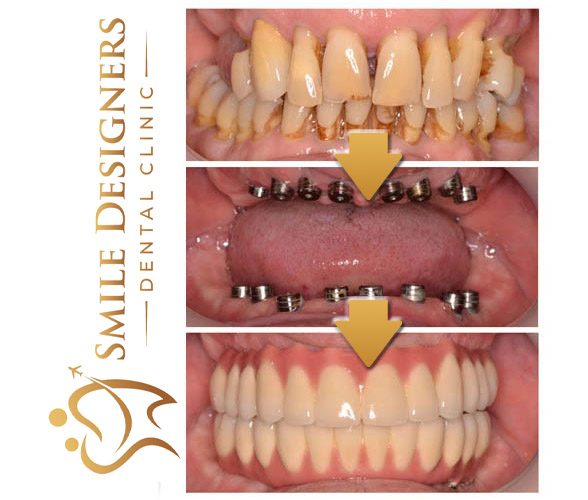 Komplett festsitzender Zahnersatz - Smile DesignersSmile Designers