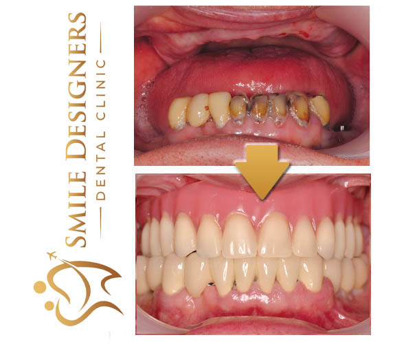 Implantatgetragene Prothesen - Smile DesignersSmile Designers