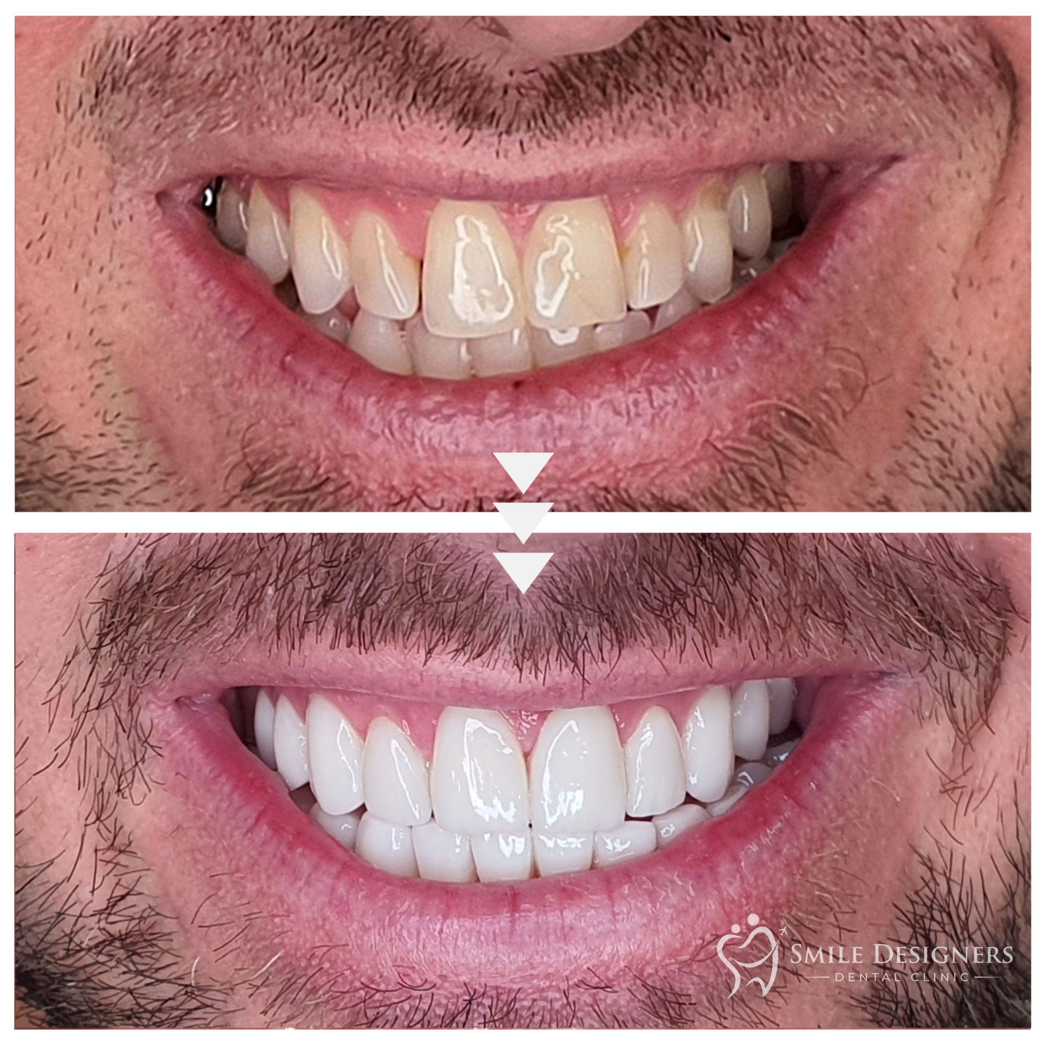 Lumineers oder E.Max ZahnVeneer? Smile Designers